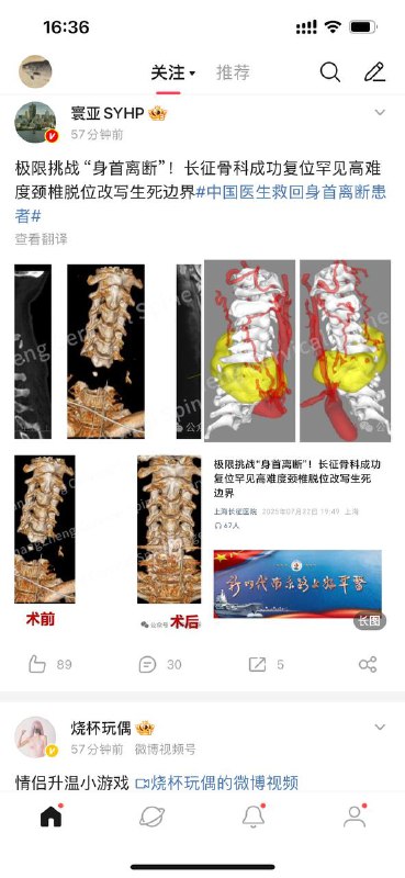 首例“身首离断”手术获得成功首例“身首离断”手术获得成功
