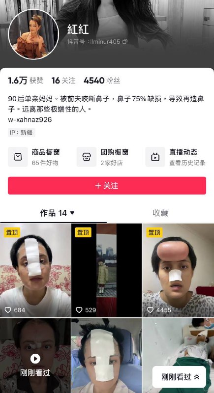 #新疆 被前夫咬掉鼻子 👃植皮#新疆 被前夫咬掉鼻子 👃植皮