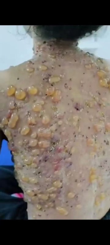 猴痘病患视频，#慎入 ，尤其是密集恐惧症者