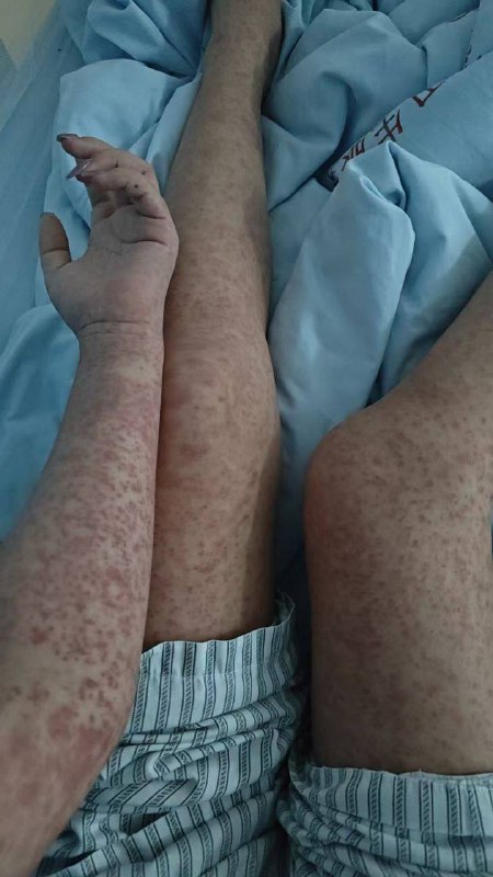 广州  基孔 肯雅热 蚊子 疫情广州  基孔 肯雅热 蚊子 疫情