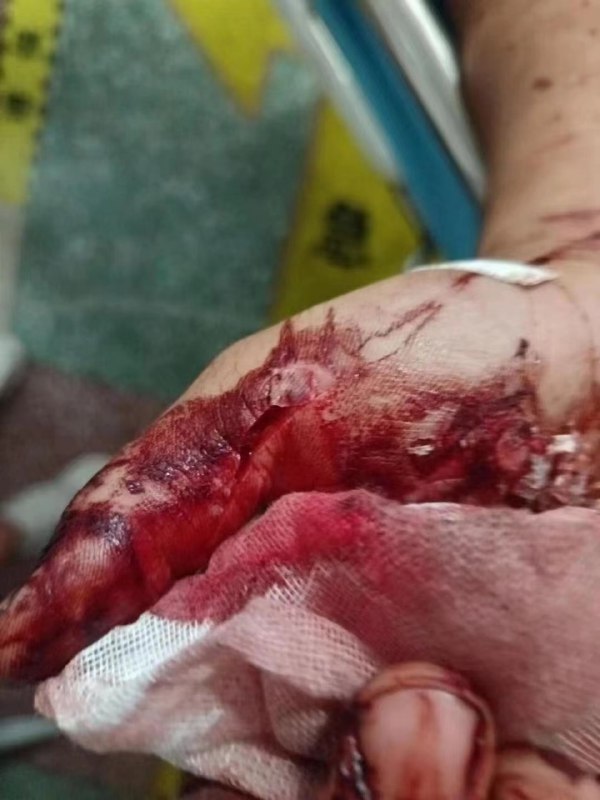 7.27河南省南阳市镇平县万德隆金街二楼砍人事件，当地公安不作为，至今没有解决 #刀仔🔪7.27河南省南阳市镇平县万德隆金街二楼砍人事件，当地公安不作为，至今没有解决 #刀仔🔪