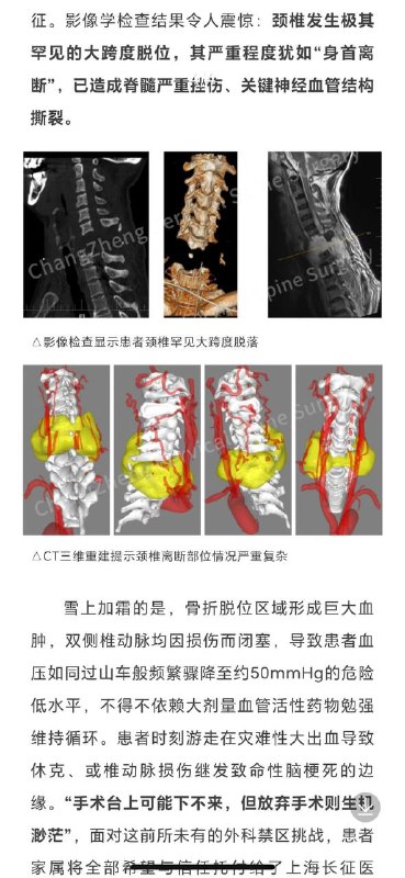 首例“身首离断”手术获得成功首例“身首离断”手术获得成功