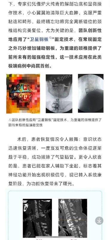 首例“身首离断”手术获得成功首例“身首离断”手术获得成功