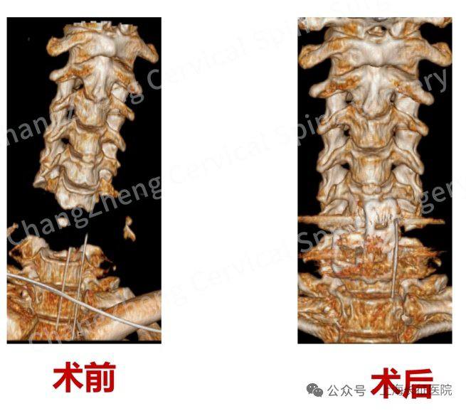 首例“身首离断”手术获得成功首例“身首离断”手术获得成功